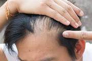 Men's Hair Transplant and Medical Hair Restoration